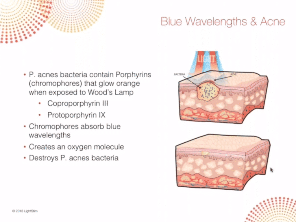 blue wavelength & acne
